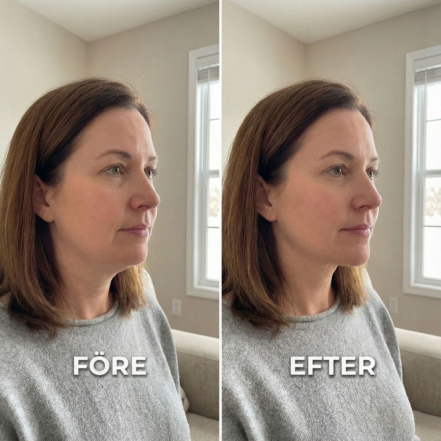 Kontura Lifter - Minimerar Dubbelhakan Utan Ingrepp!